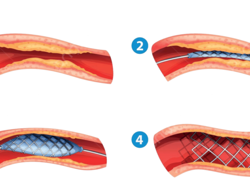 HABLEMOS DE CATETERISMO Y ANGIOPLASTIA